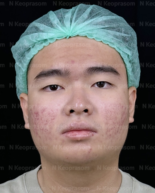 คุณฮิว before
