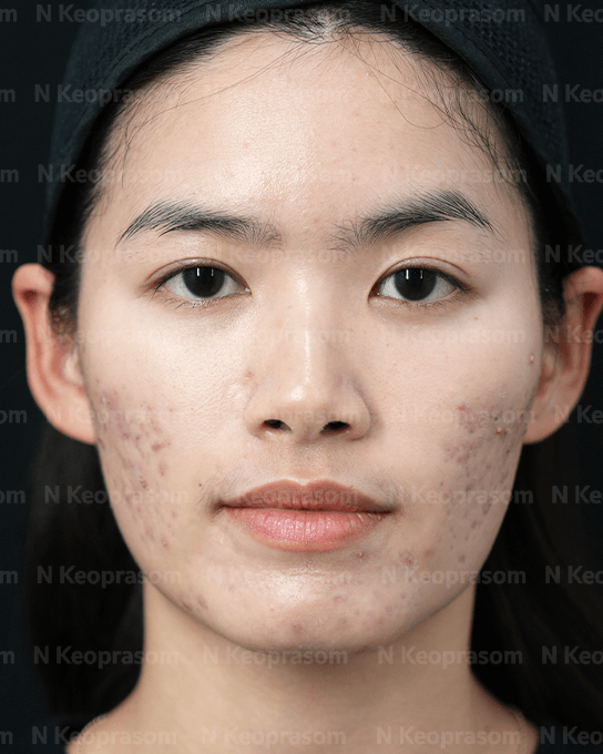 คุณพิมพ์ before