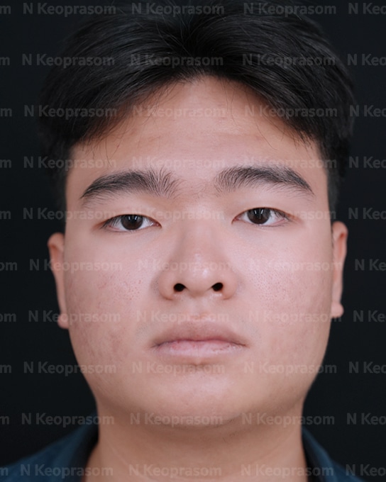 คุณฮิว after