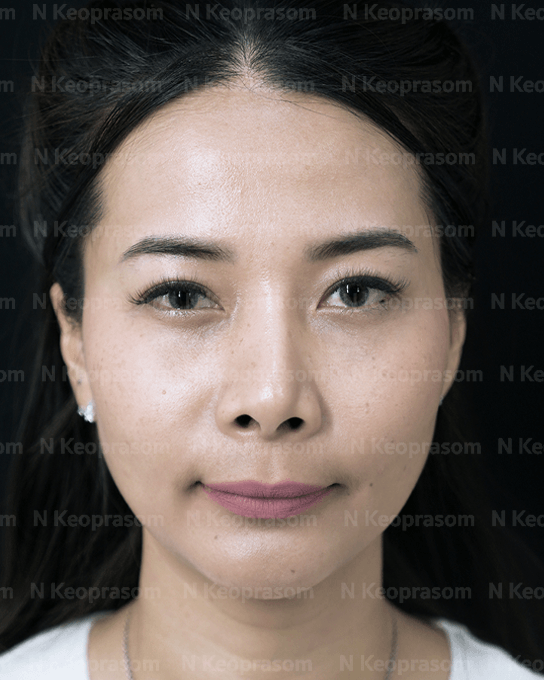 คุณจี after
