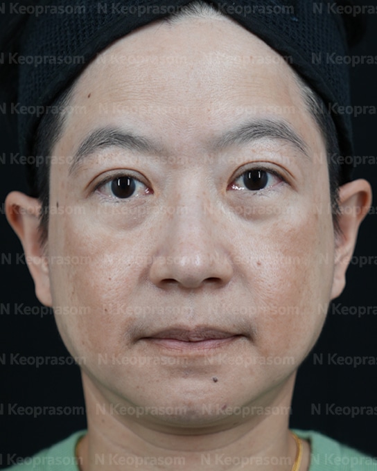 คุณนก before