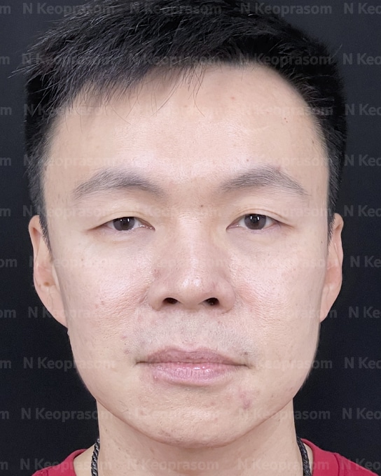 คุณปิง before