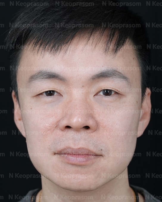 คุณปิง after