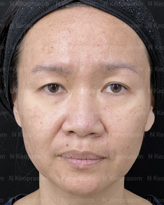 คุณอัม before