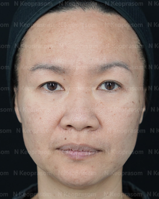 คุณอัม after
