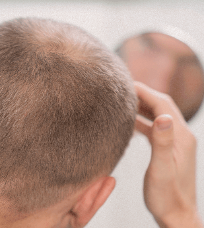 FUT hair transplant consultation