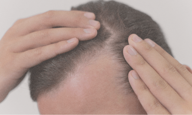Genetic hair loss assessment