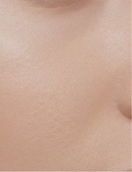 Fractional Non-Ablative Technology