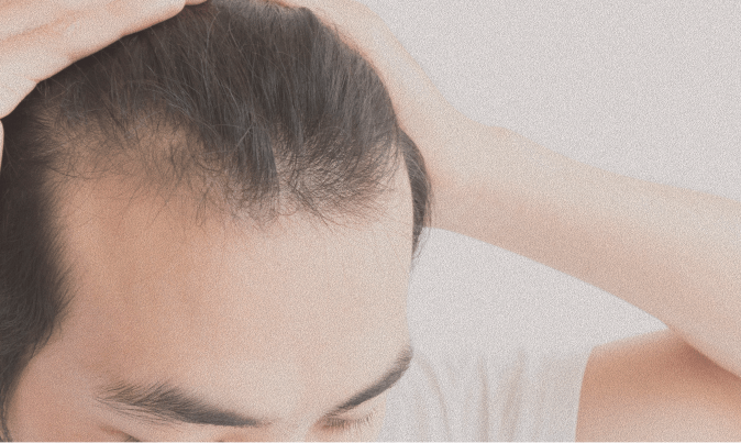 FUE hairline