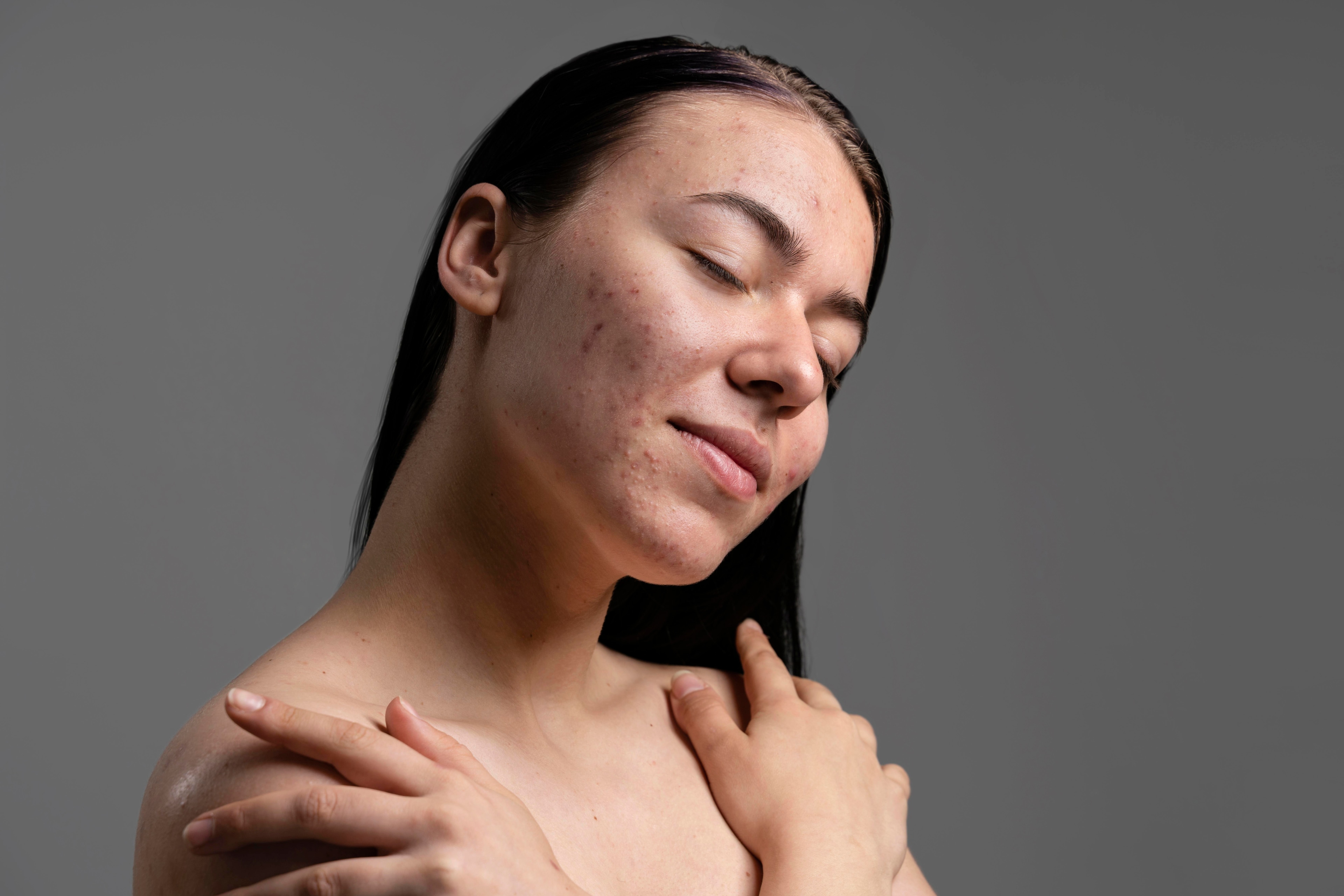 Acne and scars program