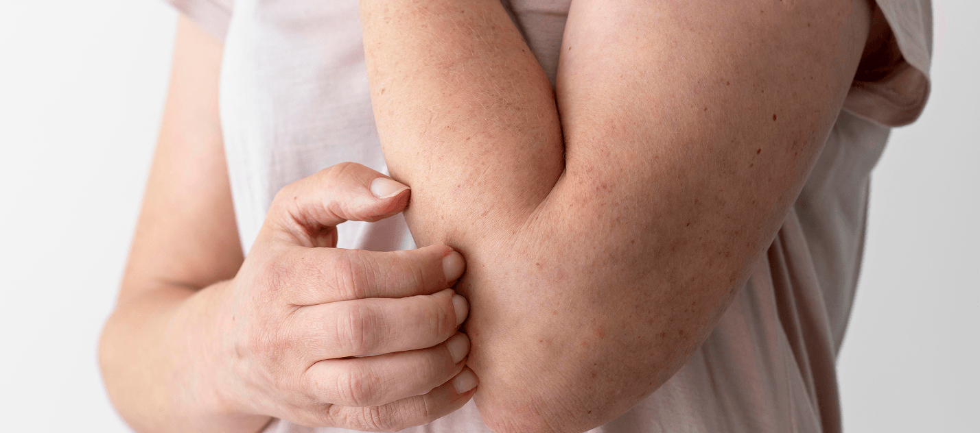 Eczema care program banner