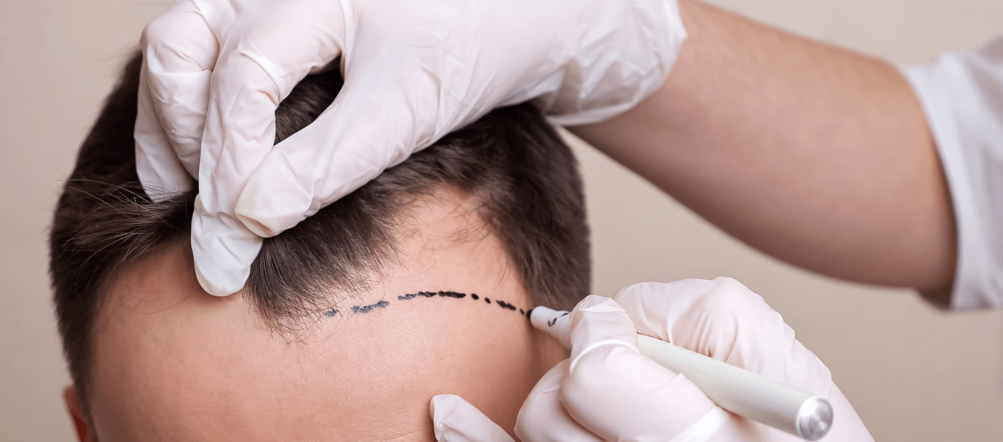 FUE hair transplant program banner