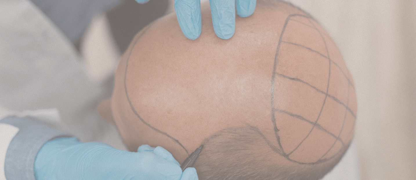 FUE scalp planning