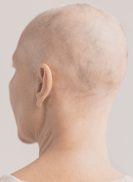 Hair loss assessment