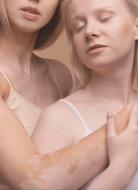People living with vitiligo