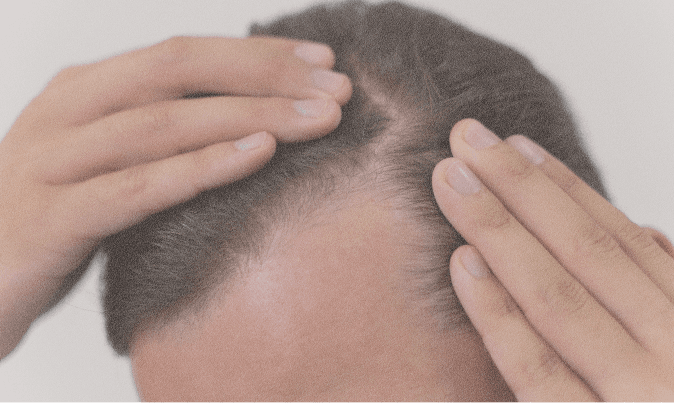 Genetic hair loss assessment