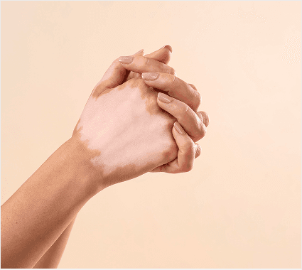 Vitiligo self care