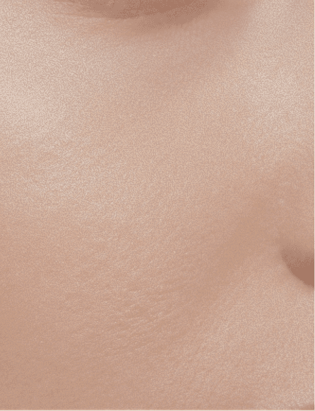 Fractional Non-Ablative Technology