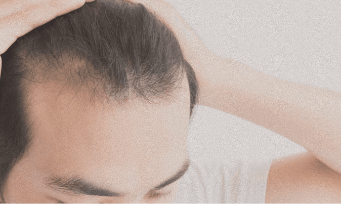 FUE hairline
