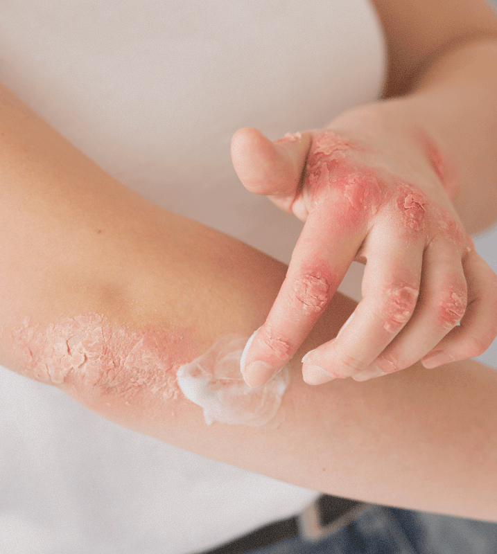 Personalized eczema care