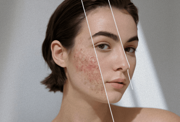Acne treatment introduction