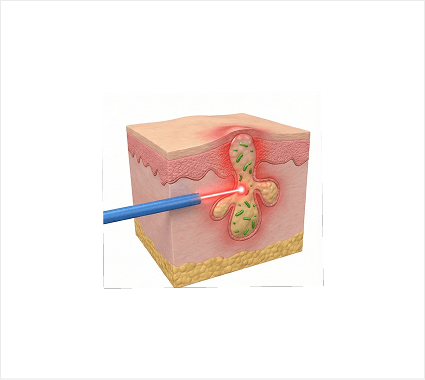 Acne treatment consultation