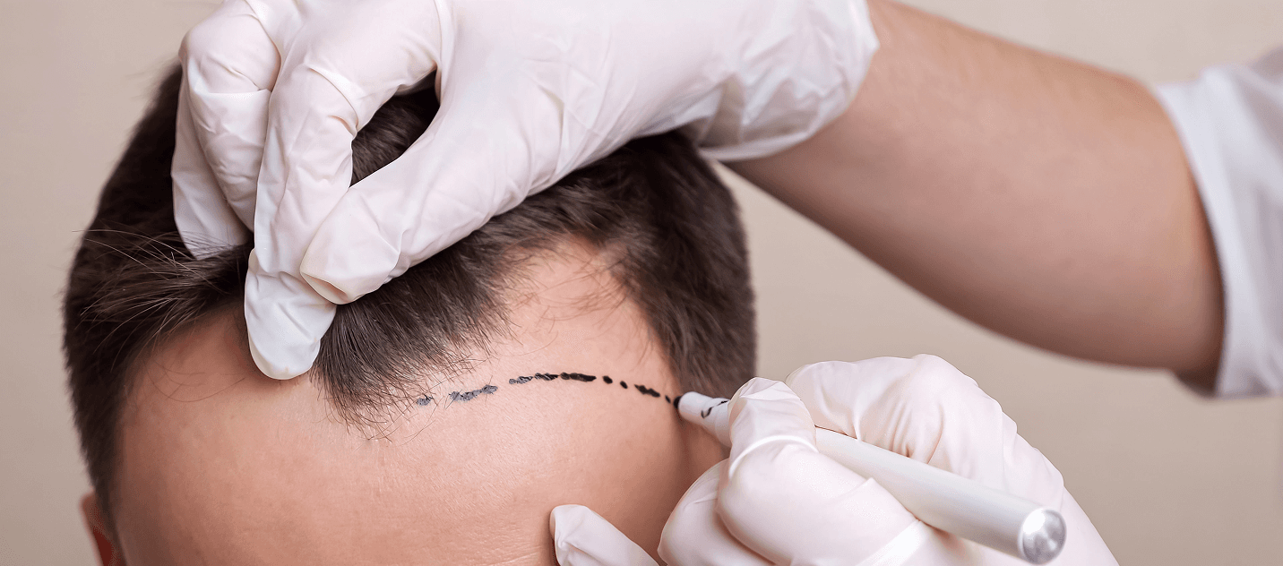 FUE hair transplant program banner