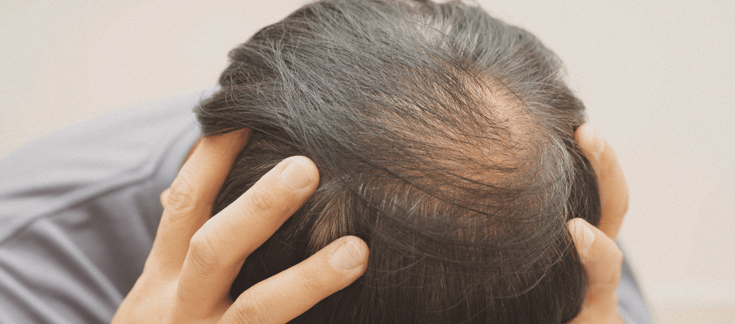 Alopecia and hair loss program banner