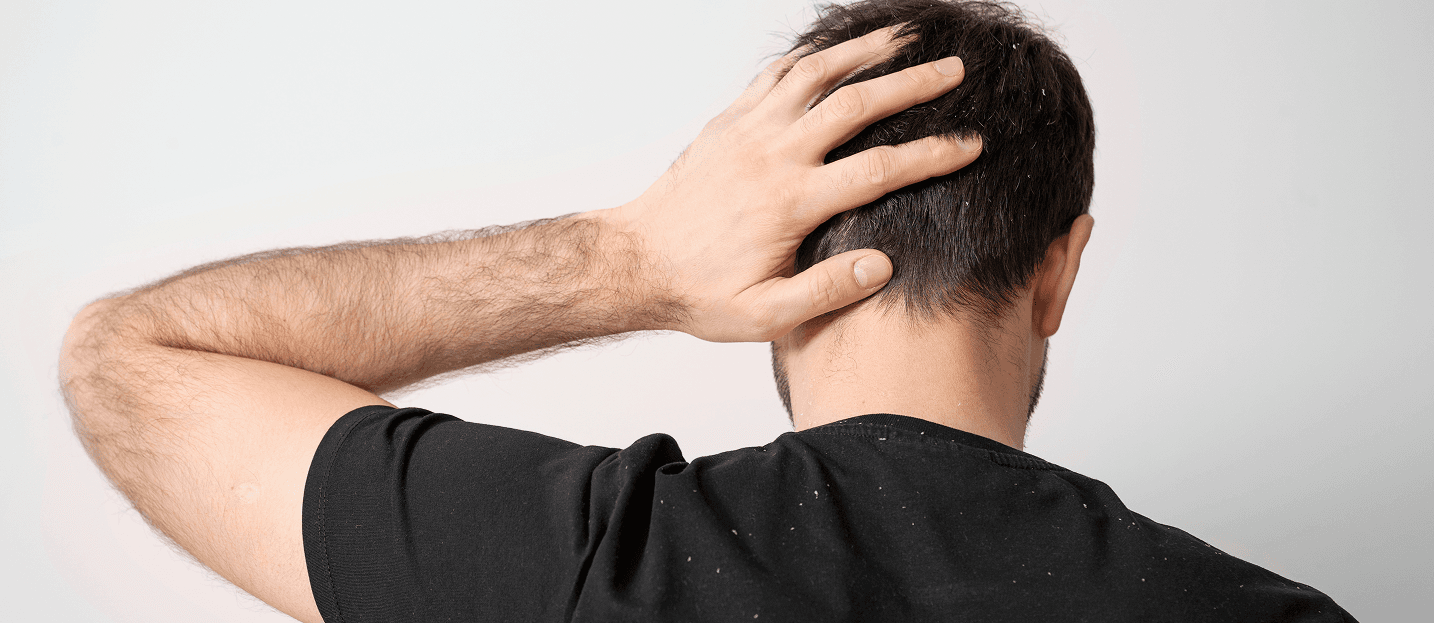 Dandruff and itchy scalp program
