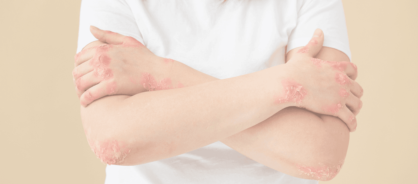 Psoriasis program banner