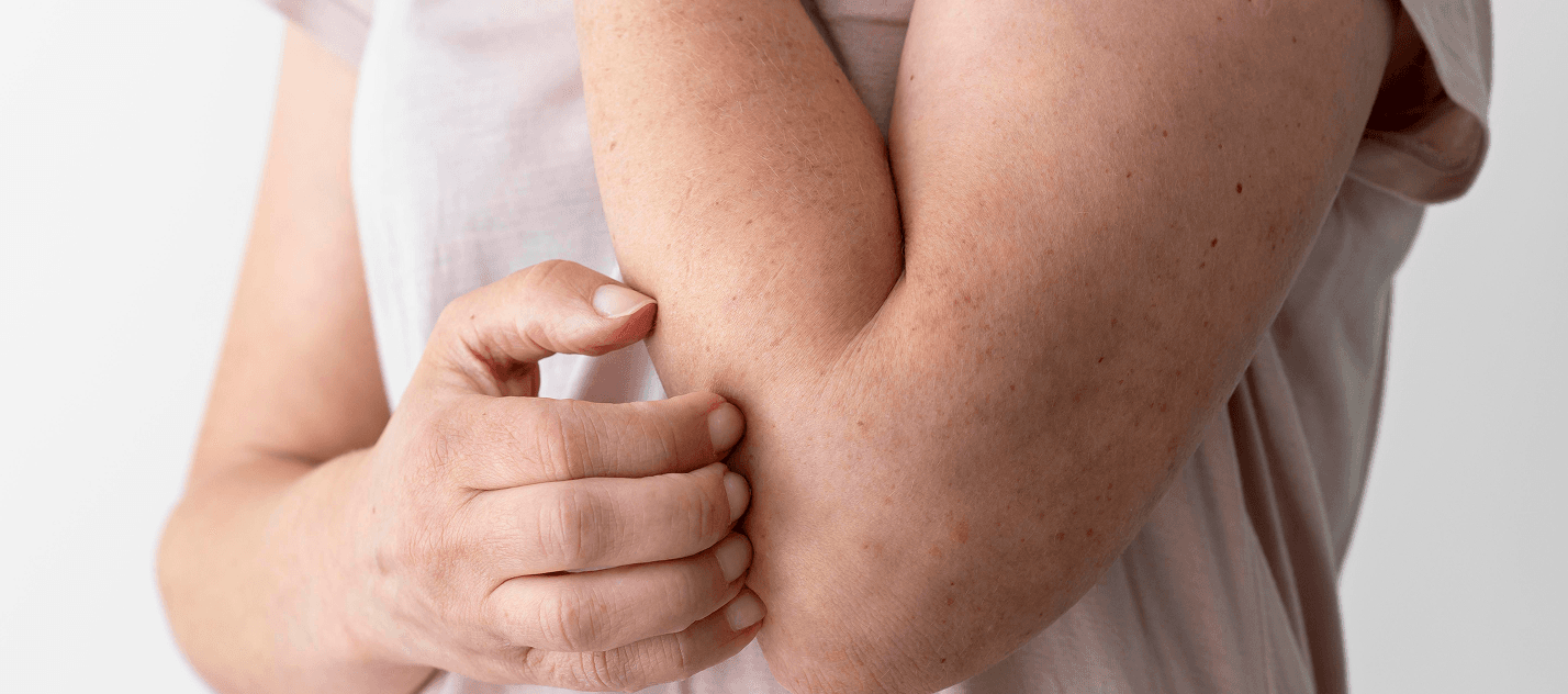 Eczema care program banner