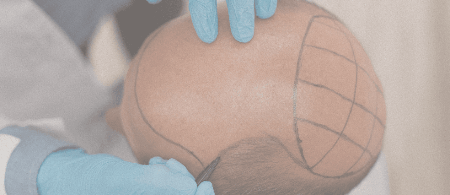 FUE scalp planning