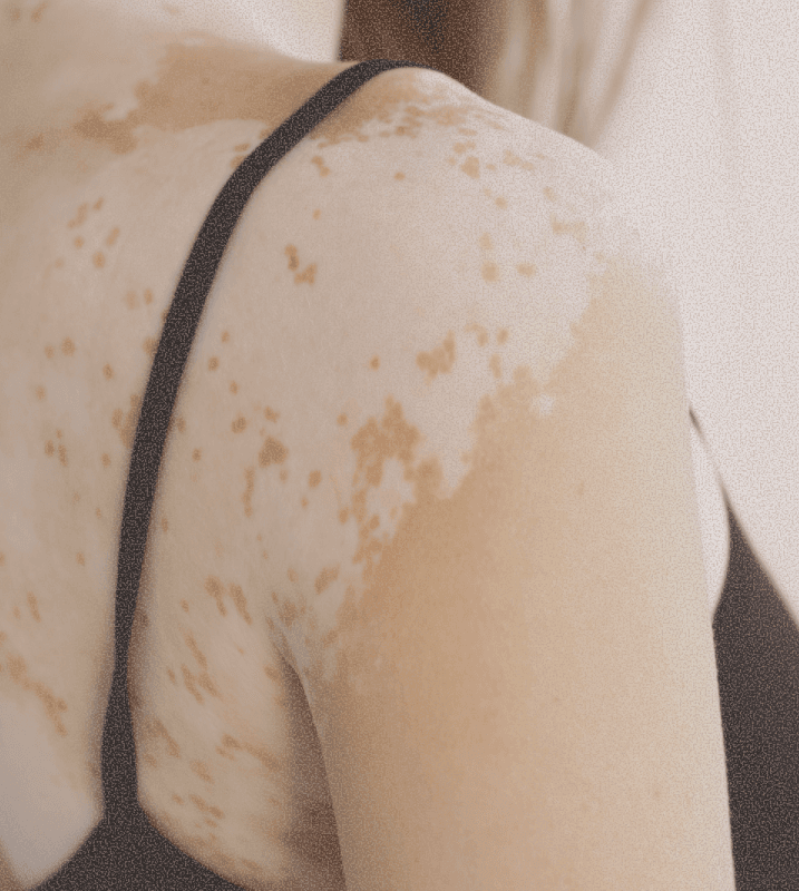 Vitiligo on the shoulder