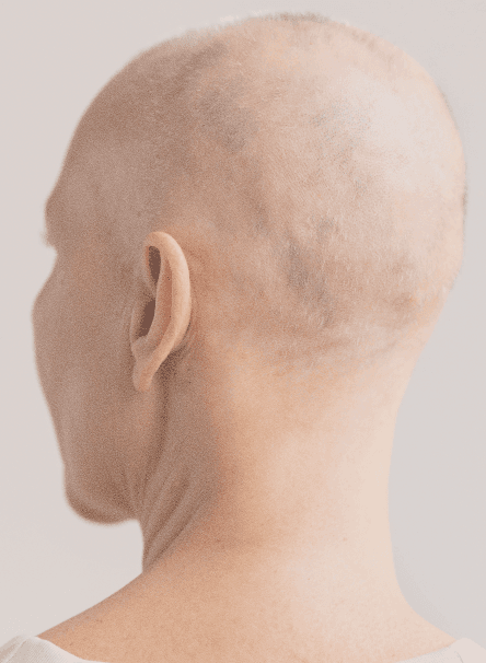 Hair loss assessment