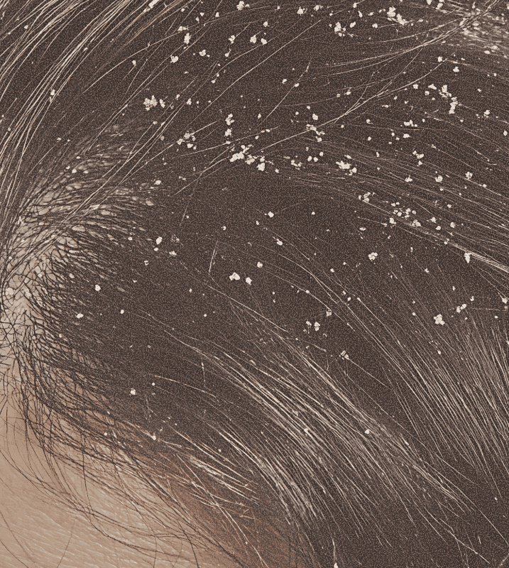 Close view of scalp flakes