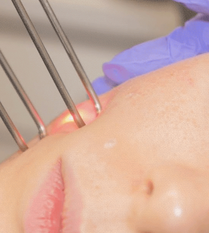 Light Scan treatment device