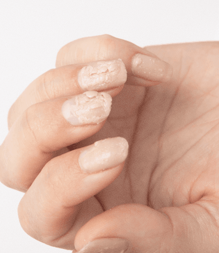 Nail disorder consultation
