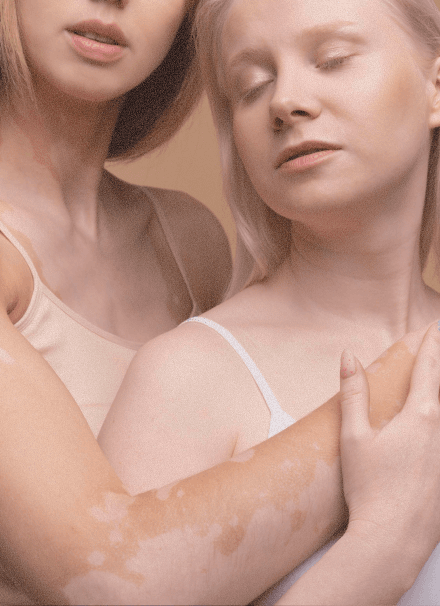 People living with vitiligo