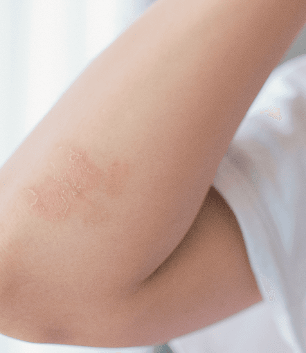 Psoriasis on hands
