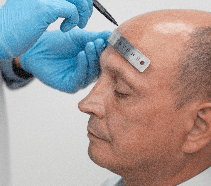 FUT hair transplant assessment