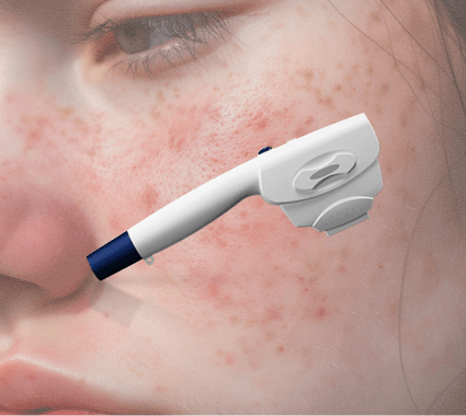 IPL (Intense Pulsed Light)